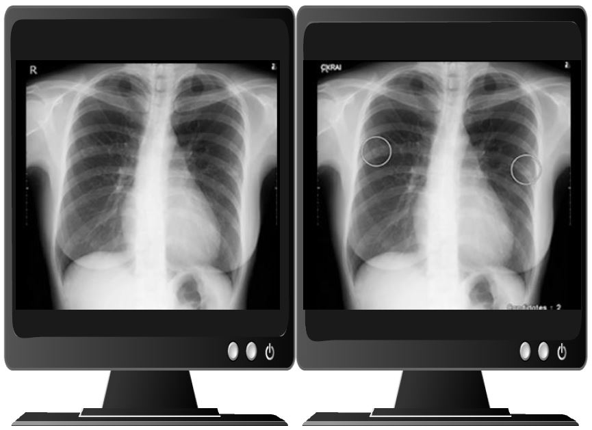 胸部X線画像診断支援AI　Clairvo CXR-AI